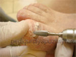 Фото ногтей во время процедуры медицинского педикюра